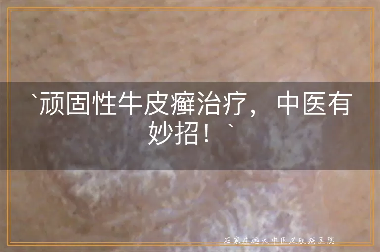 顽固性牛皮癣治疗，中医有妙招！