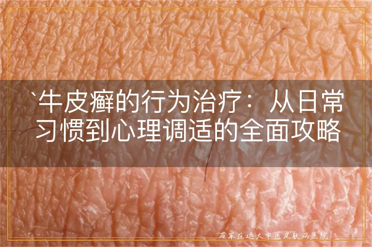 牛皮癣的行为治疗:从日常习惯到心理调适的全面攻略