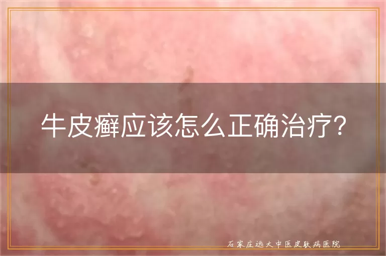 牛皮癣应该怎么正确治疗？