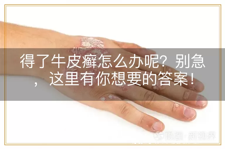 得了牛皮癣怎么办呢？别急，这里有你想要的答案！