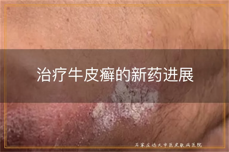 治疗牛皮癣的新药进展