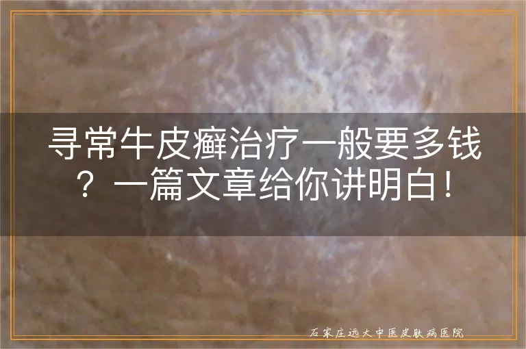寻常牛皮癣治疗一般要多钱？一篇文章给你讲明白！