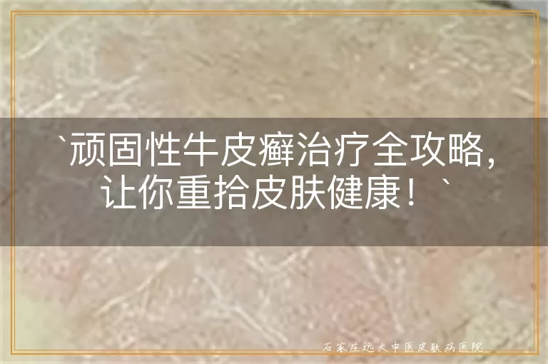 顽固性牛皮癣治疗全攻略，让你重拾皮肤健康！