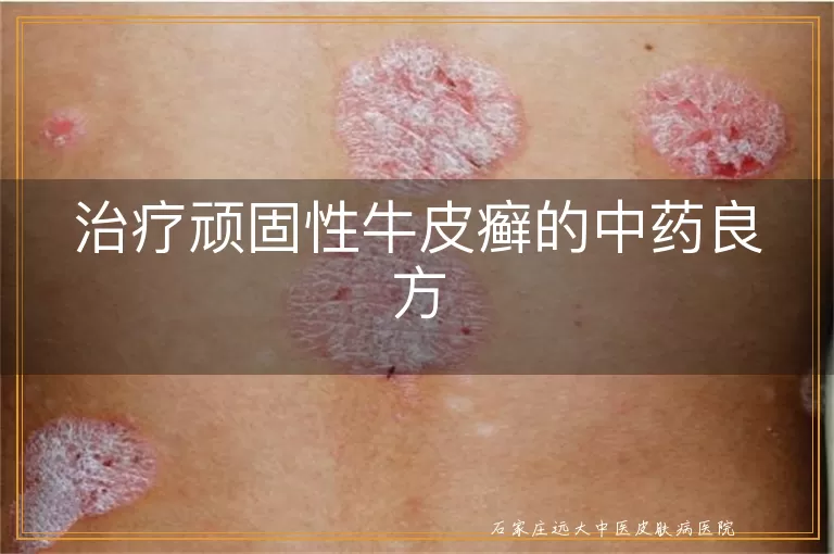 治疗顽固性牛皮癣的中药良方