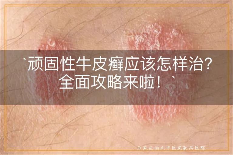 顽固性牛皮癣应该怎样治?全面攻略来啦!