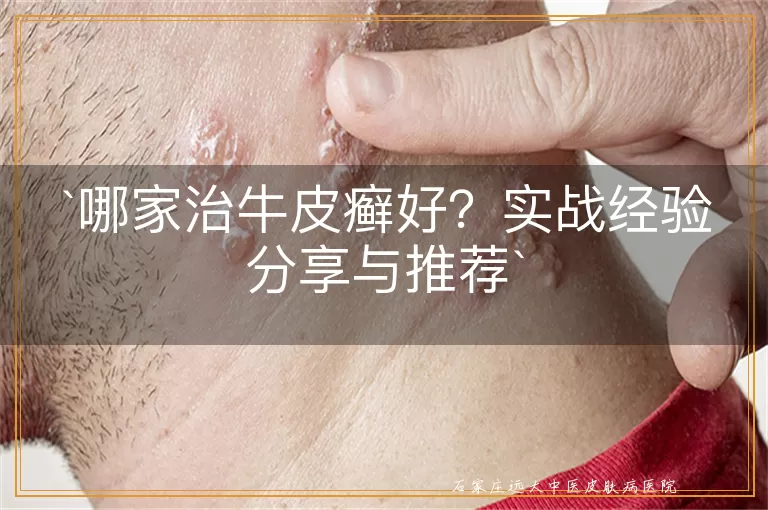 哪家治牛皮癣好？实战经验分享与推荐
