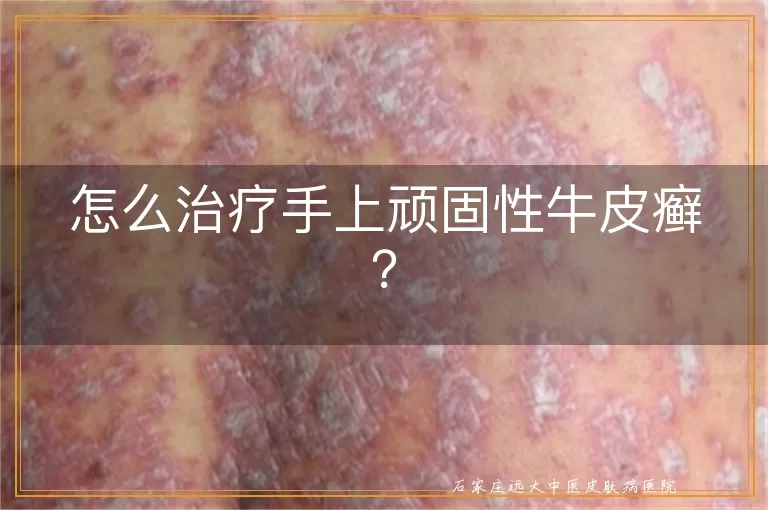 怎么治疗手上顽固性牛皮癣?