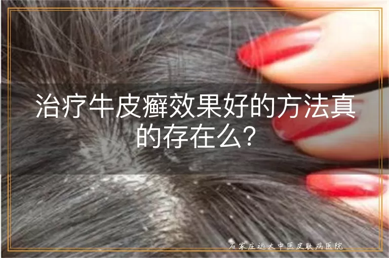 治疗牛皮癣效果好的方法真的存在么？