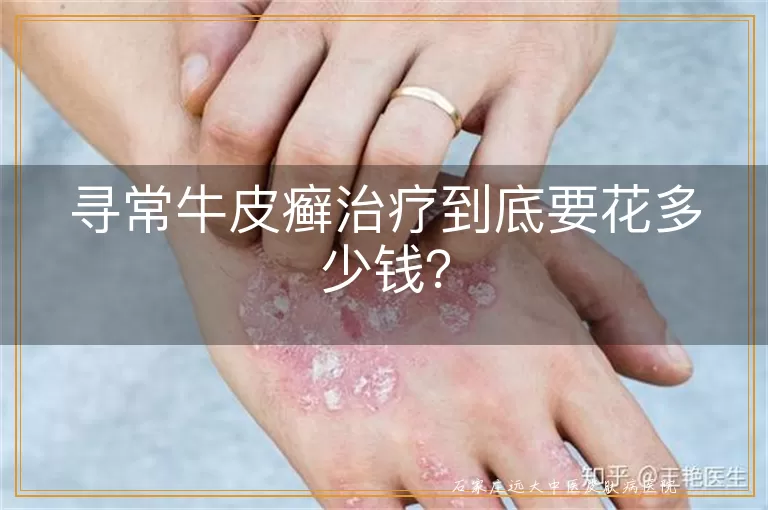 寻常牛皮癣治疗到底要花多少钱？