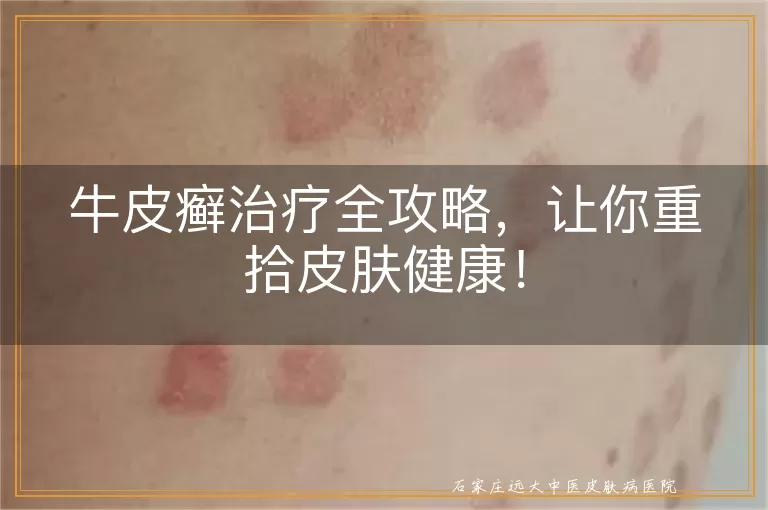 牛皮癣治疗全攻略，让你重拾皮肤健康！