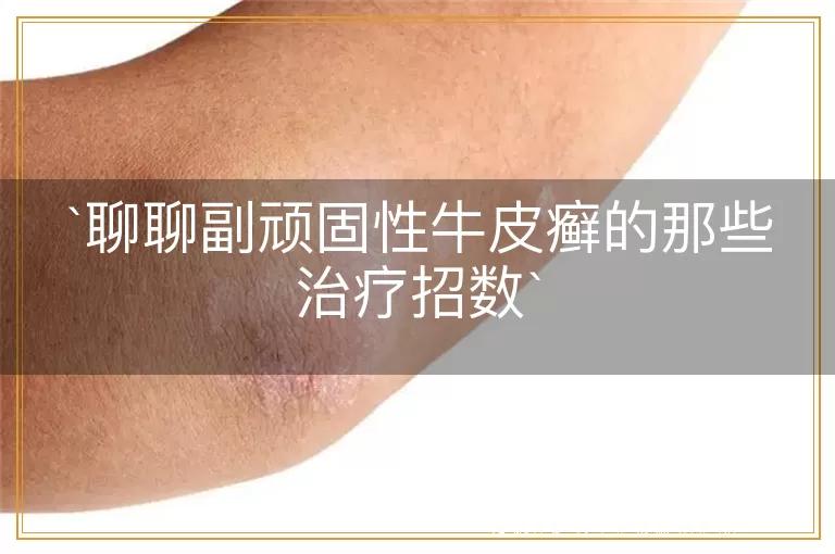 聊聊副顽固性牛皮癣的那些治疗招数