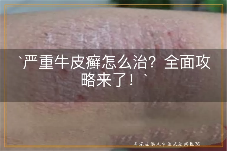 严重牛皮癣怎么治?全面攻略来了!
