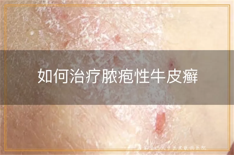 如何治疗脓疱性牛皮癣