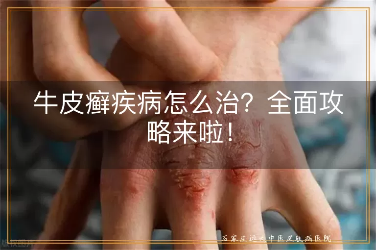 牛皮癣疾病怎么治？全面攻略来啦！