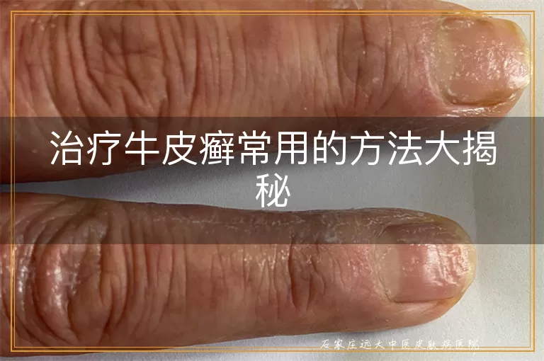 治疗牛皮癣常用的方法大揭秘