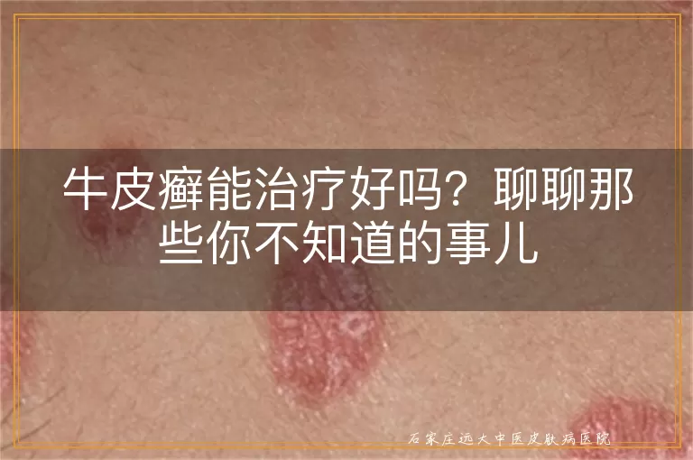 牛皮癣能治疗好吗？聊聊那些你不知道的事儿