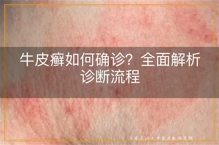 牛皮癣如何确诊？全面解析诊断流程