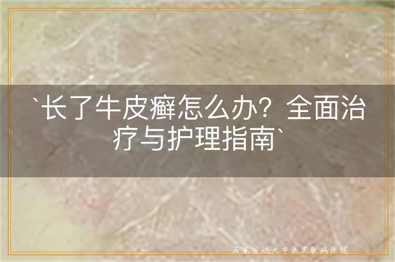 长了牛皮癣怎么办?全面治疗与护理指南