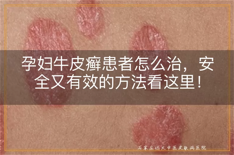 孕妇牛皮癣患者怎么治，安全又有效的方法看这里！