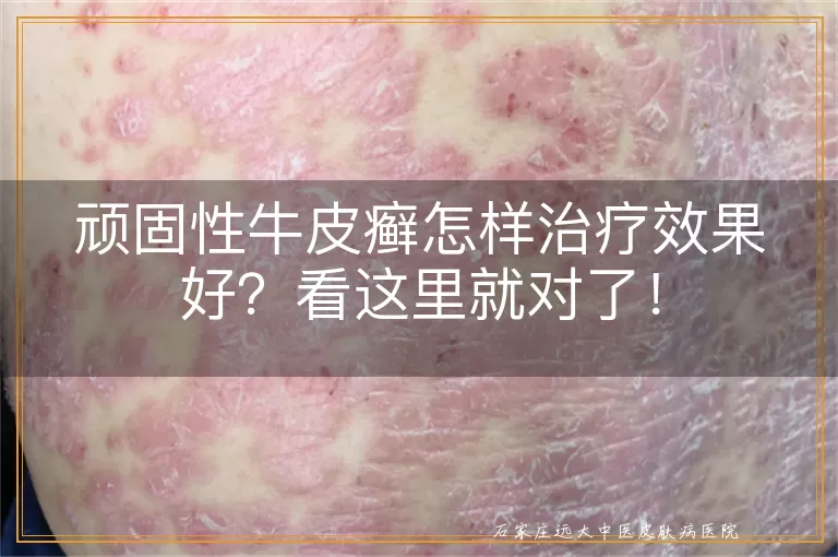 顽固性牛皮癣怎样治疗效果好?看这里就对了!