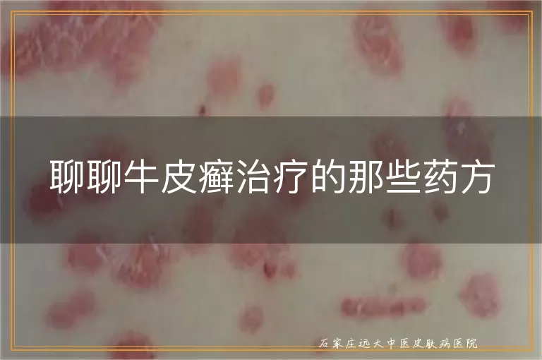 聊聊牛皮癣治疗的那些药方