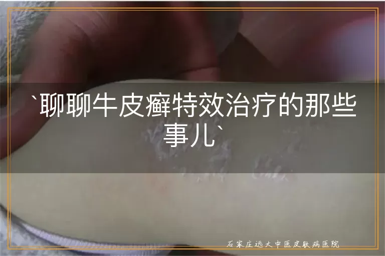 聊聊牛皮癣特效治疗的那些事儿