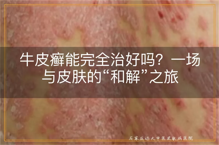 牛皮癣能完全治好吗？一场与皮肤的“和解”之旅