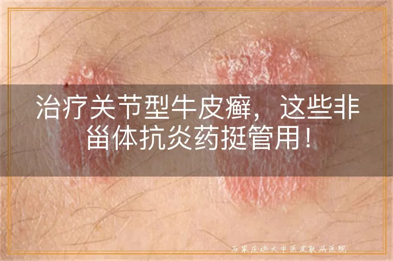 治疗关节型牛皮癣，这些非甾体抗炎药挺管用！