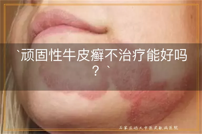 顽固性牛皮癣不治疗能好吗？