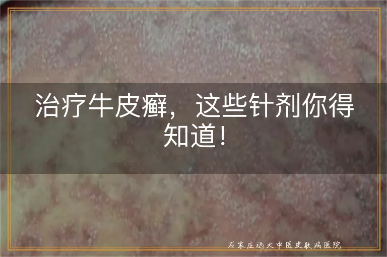 治疗牛皮癣，这些针剂你得知道！