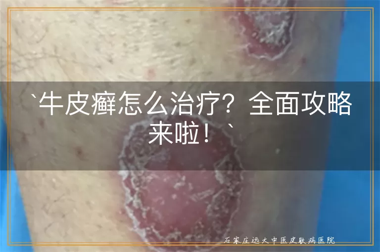 牛皮癣怎么治疗？全面攻略来啦！