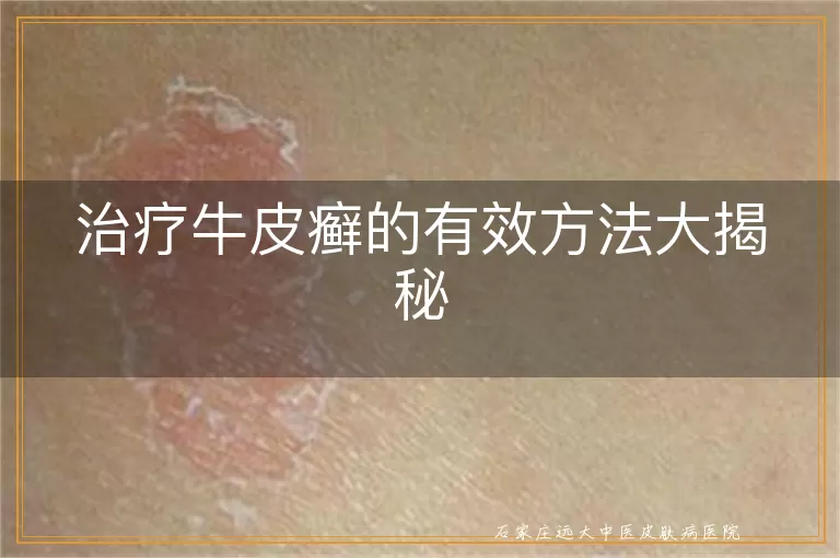 治疗牛皮癣的有效方法大揭秘
