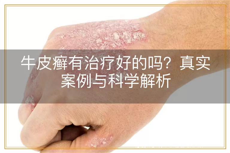 牛皮癣有治疗好的吗？真实案例与科学解析