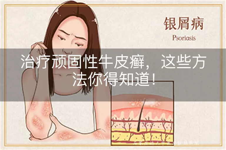 治疗顽固性牛皮癣，这些方法你得知道！