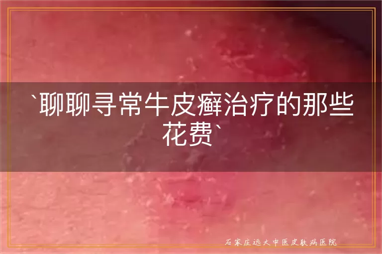 聊聊寻常牛皮癣治疗的那些花费