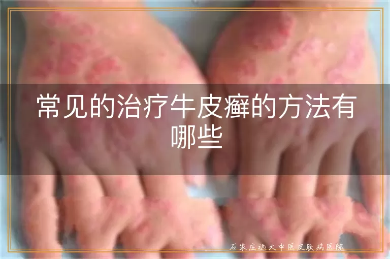 常见的治疗牛皮癣的方法有哪些