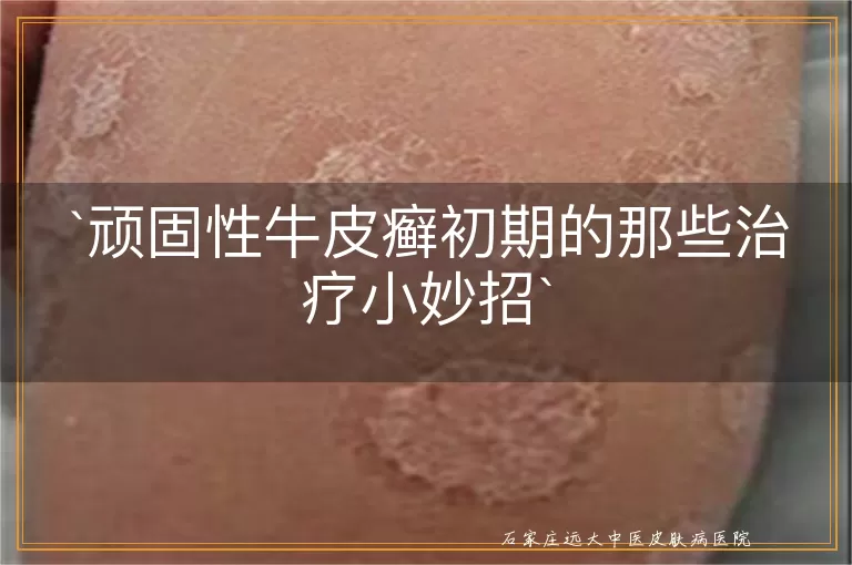 顽固性牛皮癣初期的那些治疗小妙招