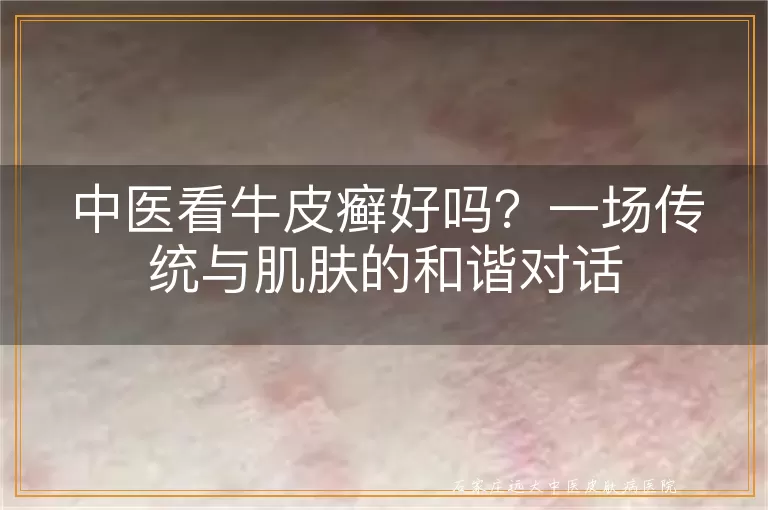 中医看牛皮癣好吗？一场传统与肌肤的和谐对话
