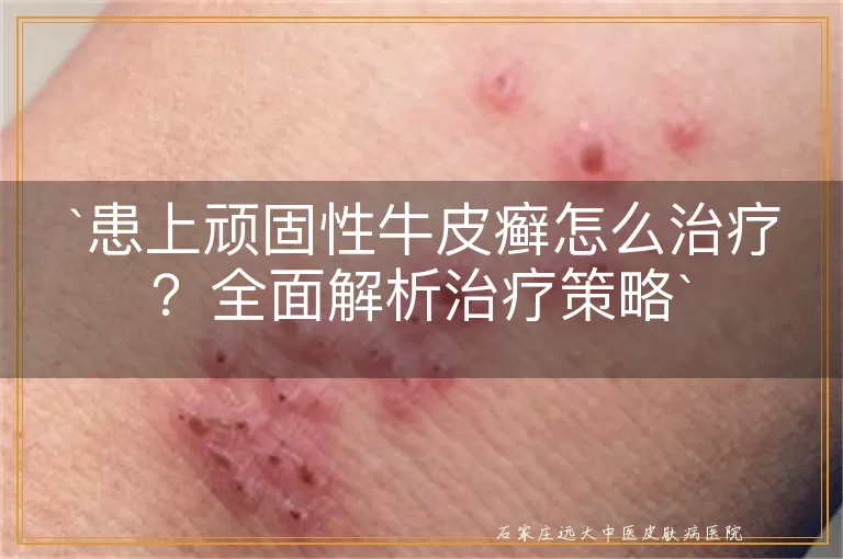 患上顽固性牛皮癣怎么治疗？全面解析治疗策略