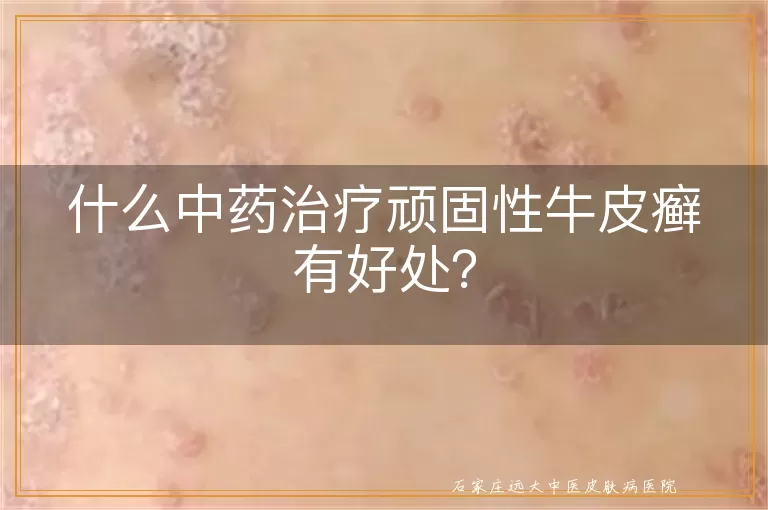什么中药治疗顽固性牛皮癣有好处？