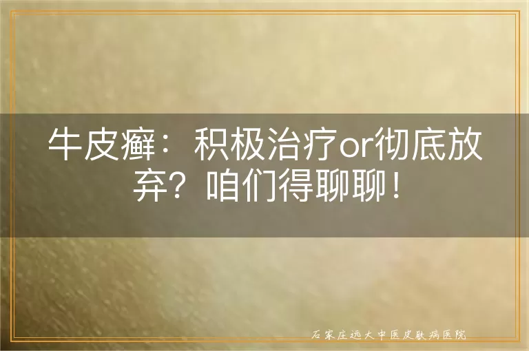 牛皮癣：积极治疗or彻底放弃？咱们得聊聊！