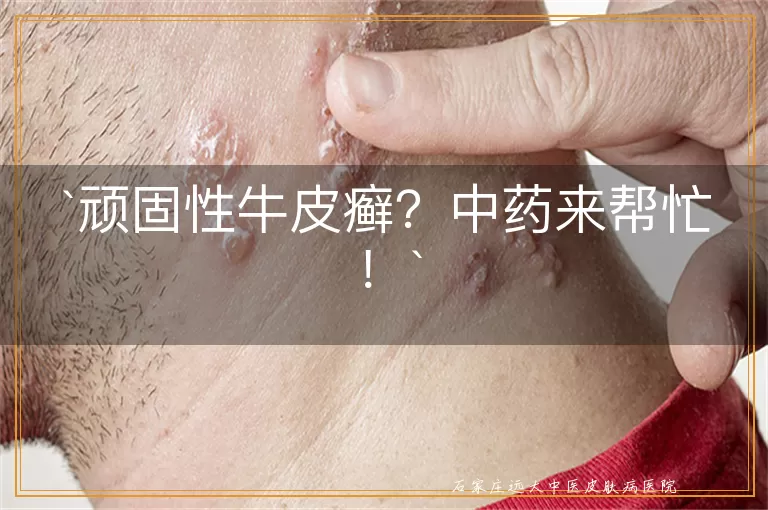 顽固性牛皮癣？中药来帮忙！