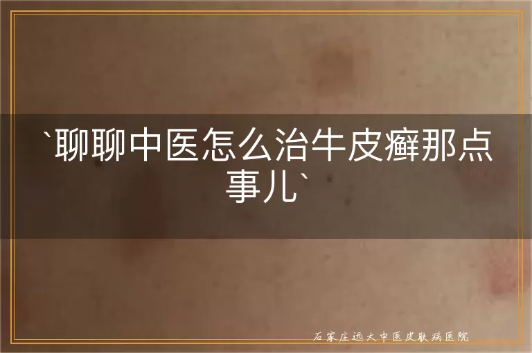 聊聊中医怎么治牛皮癣那点事儿