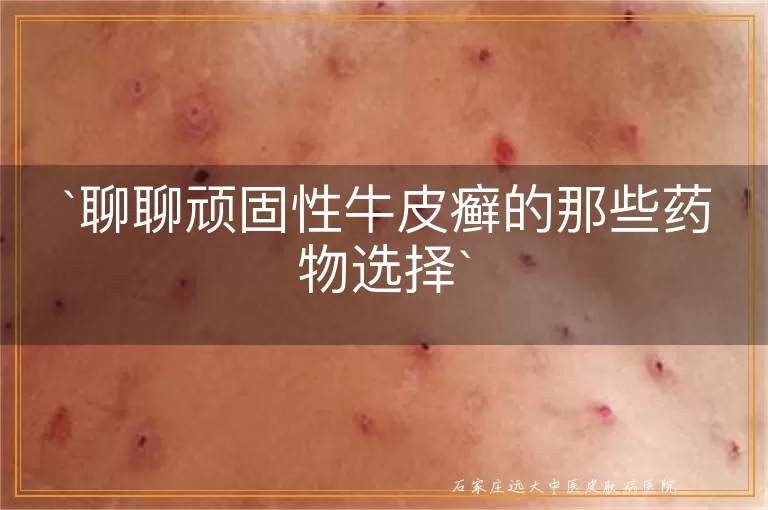 聊聊顽固性牛皮癣的那些药物选择