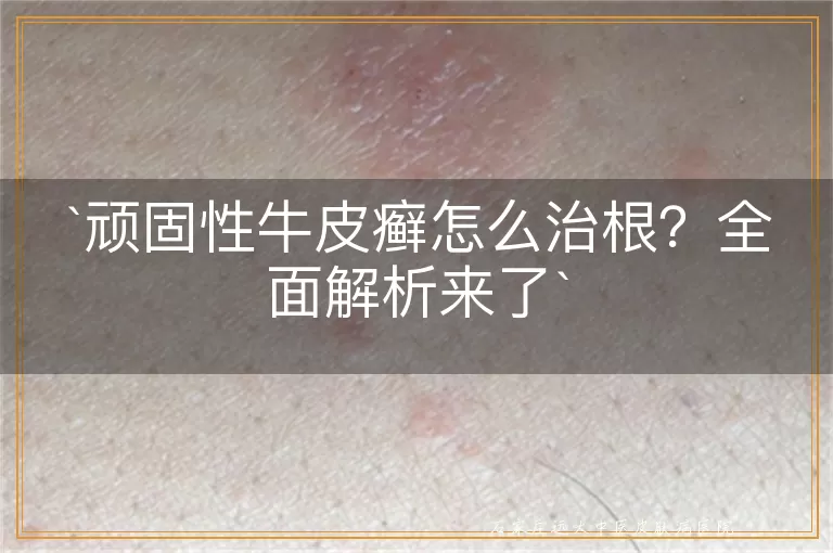 顽固性牛皮癣怎么治根?全面解析来了