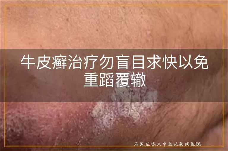 牛皮癣治疗勿盲目求快以免重蹈覆辙