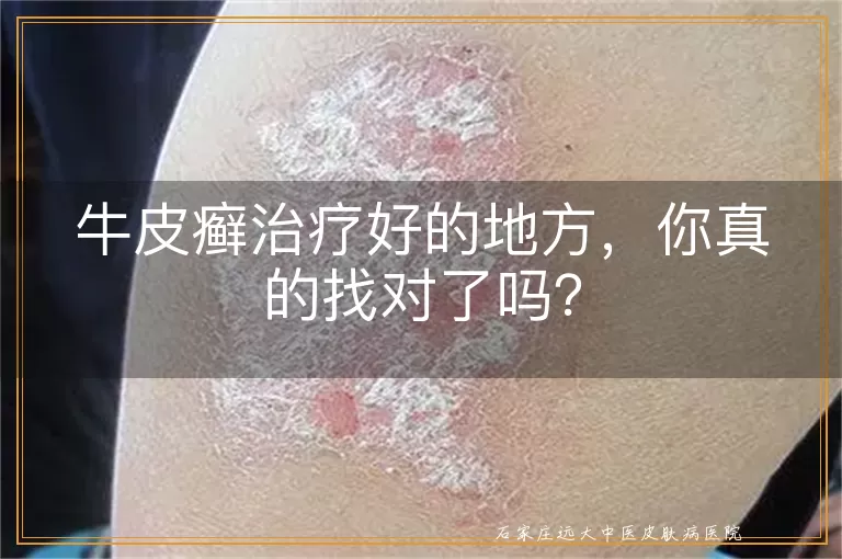 牛皮癣治疗好的地方，你真的找对了吗？