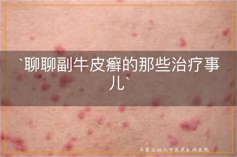 聊聊副牛皮癣的那些治疗事儿