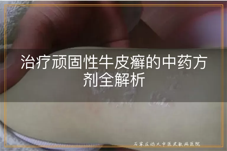 治疗顽固性牛皮癣的中药方剂全解析
