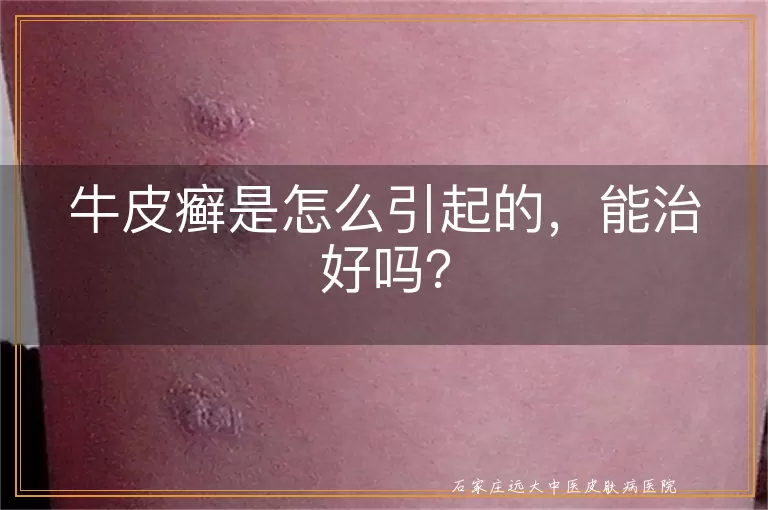 牛皮癣是怎么引起的,能治好吗?